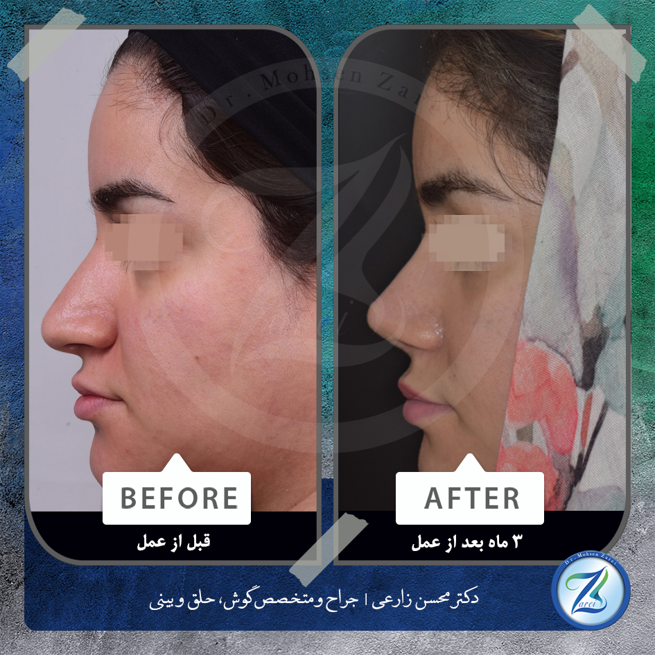 نمونه جراحی زیبایی بینی دکتر زارعی3