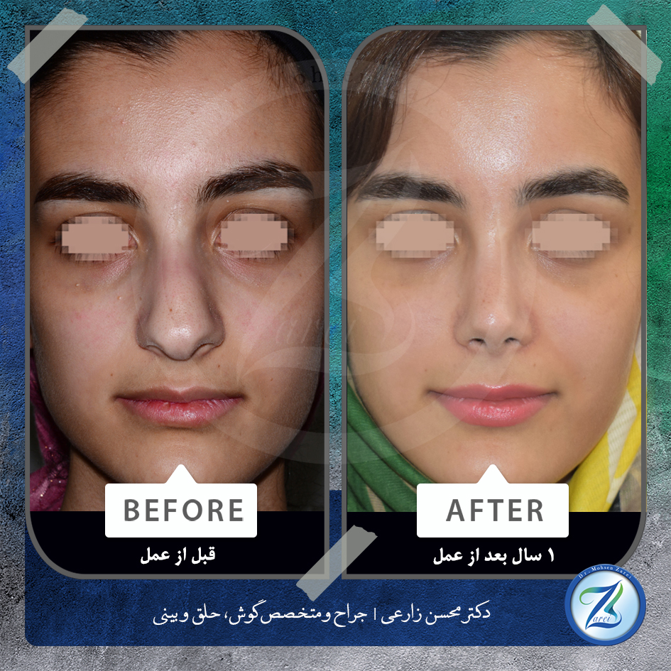 نمونه جراحی زیبایی بینی دکتر زارعی2