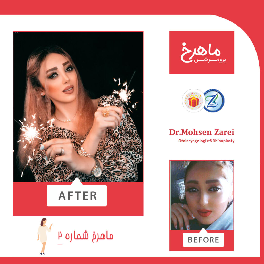 قبل و بعد از عمل بینی توسط دکتر محسن زارعی