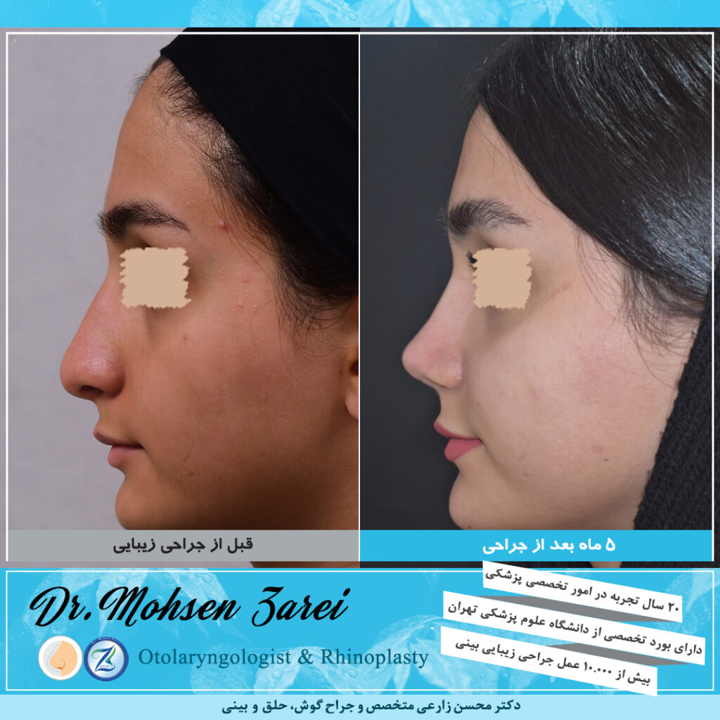 نمونه عمل زیبایی بینی دکتر محسن زارعی35