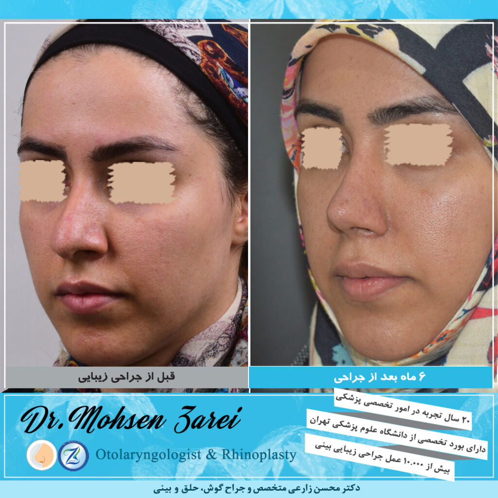 نمونه عمل زیبایی بینی دکتر محسن زارعی20
