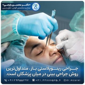 جراحی رینوپلاستی باز، متداول‌ترین روش جراحی بینی در میان پزشکان است. 